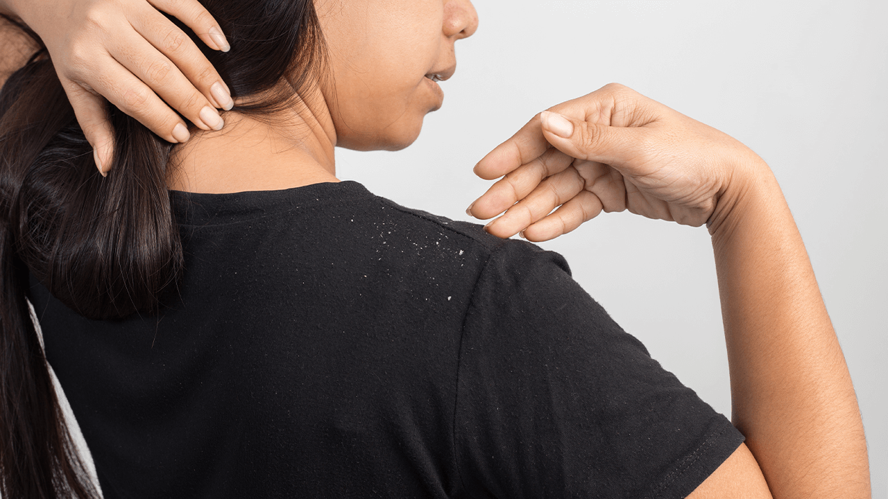 Remedies to Get Rid of Dandruff Effectively - Tips & Remedies